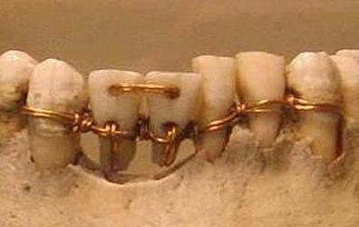 ANCIENT HISTORY The dental implant of today seems like the most modern of technology, but dental implants have actually been around for thousands of years.