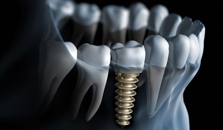 RELATED PROCEDURES Sometimes advance work is needed prior to a dental implant. For example, one key to a successful implant is adequate bone in the upper or lower jaw.