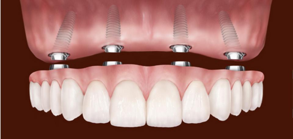 IMPLANTS FOR MULTIPLE TEETH (ALL-ON-4 PROCEDURE) Replacing multiple teeth or all of the teeth often requires the use of a general anesthetic in an outpatient surgery center.