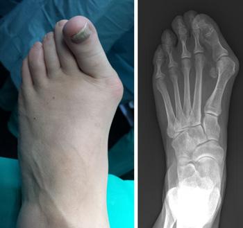 (Left) A bunion that has progressed to deformity with the big toe crossing over the second toe. (Right) An x- ray of the same bunion shows how far out of alignment the bones are.
