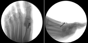 X-rays taken from the top and the side of the foot show a bunion corrected with osteotomy. Arthrodesis In this procedure, Mr.