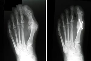 The x-ray on the left shows severe arthritis of the MTP joint. After arthrodesis (shown on the right), the entire foot is realigned.