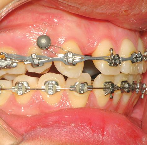 5 mm lateral to the Unitek TAD neck, which in certain cases is beneficial to prevent the orthodontic attachment mechanics from