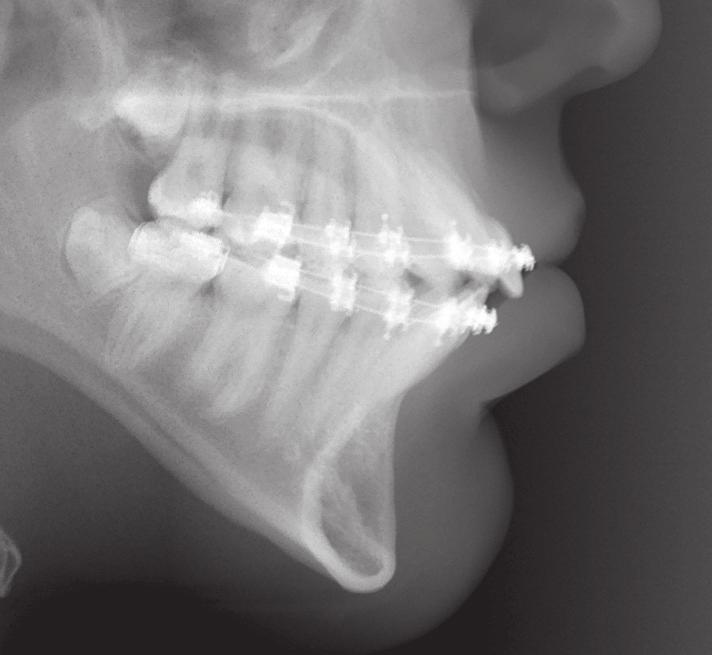 It can often be used without a periapical X-ray when interradicular spaces are fairly large