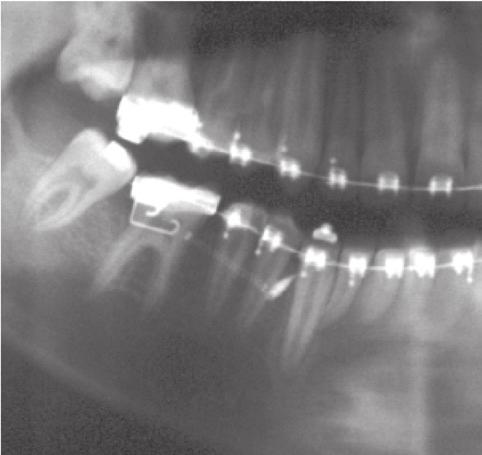 In combination with the panoramic and periapical X-rays, the clinician can determine the