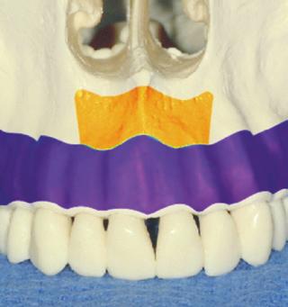 maxillary subans region, mandibular symphysis 2 mm for 6 mm 4