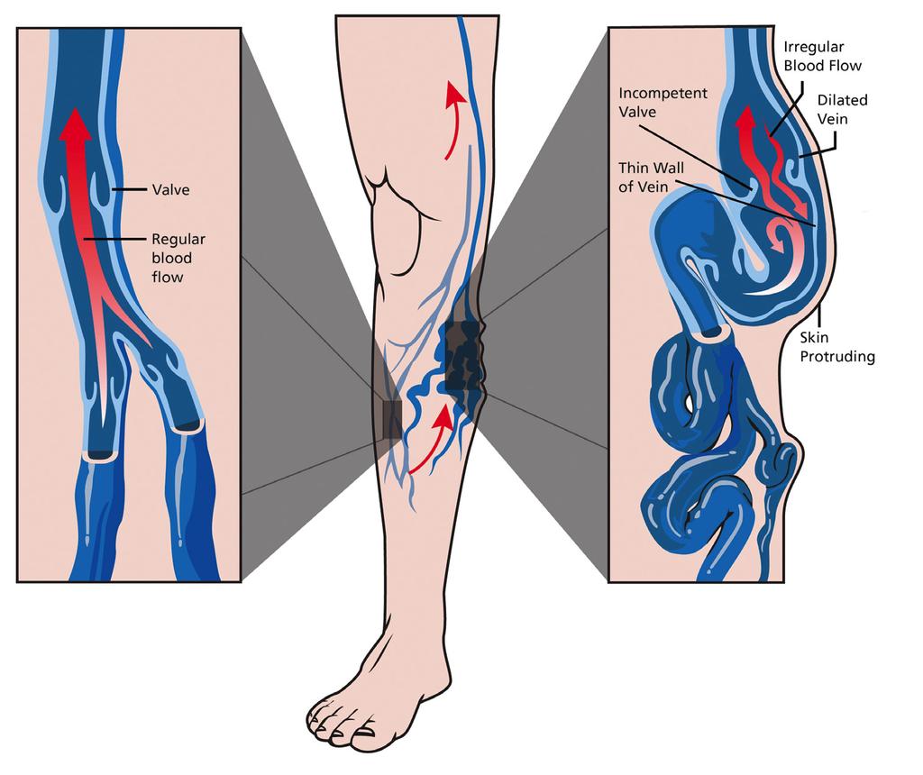 You re Not Alone Varicose veins affect an estimated 40 percent of women and 25 percent of men. Factors leading to varicose veins include heredity, gender, pregnancy, age and other factors.