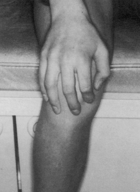 Anterior Knee Pain HISTORY: 10 15 years of age Poorly localised Usually bilateral Grab sign