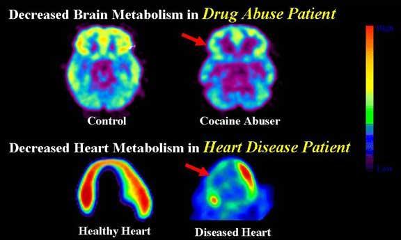 The Disease Model of Addiction Unhealthy biological structures are rightly termed