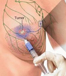 Sentinel node biopsy Previously, concepts of