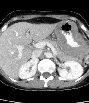Gastric MALT 1/2 of gastric lymphomas Treatment H pylori eradication CR in 50-80% Radiation