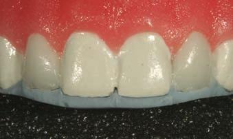 6 Microfill composites perform marginally under heavy stress-bearing areas. They exhibit superb polishability and demonstrate low wear because of their particle size and loading.