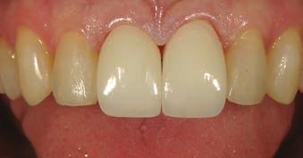The veneers were completely seated, using a total-etch technique (All-Bond 3) and A3 shade composite (Herculite, Kerr Corp).