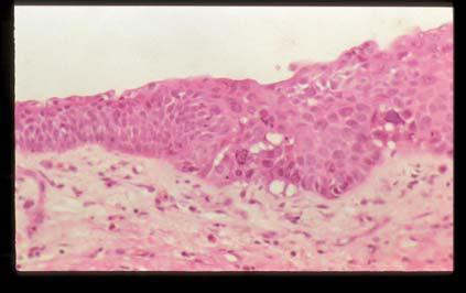 Bronchial mucosa Squamous cell