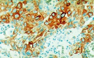 Squamous cell carcinoma Immunohistochemistry