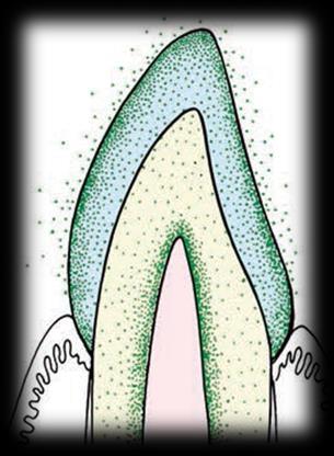 Preeruptive fluoride also results in alteration in tooth morphology by development of