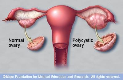 POLYCYSTIC OVARIAN SYNDROME Polycystic ovary syndrome is a common endocrine disorder affecting up to 8% of women with reproductive complications including infertility, menstrual irregularity,