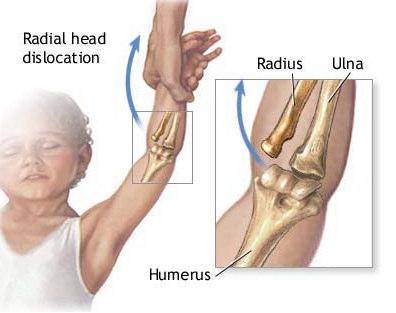 Traction applied to supinated forearm, partial tear of the annular ligament, radial head slips through the tear Reduction through supination or pronation Pulled elbow An 8 year old boy presents