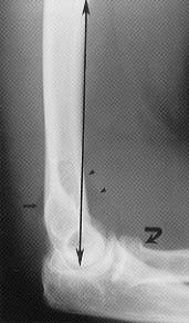 The anterior humeral line is drawn along the anterior surface of the distal humerus on a true lateral view. This should intersect the middle third of the capitellum.
