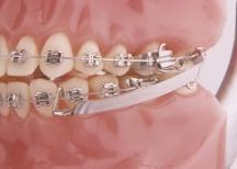 Dr. Vogt is in the private practice of orthodontics at 3501 Freemansburg Ave., Easton, PA 18045; e-mail: billvogt@rcn.com. He has a financial interest in the appliance described in this article.