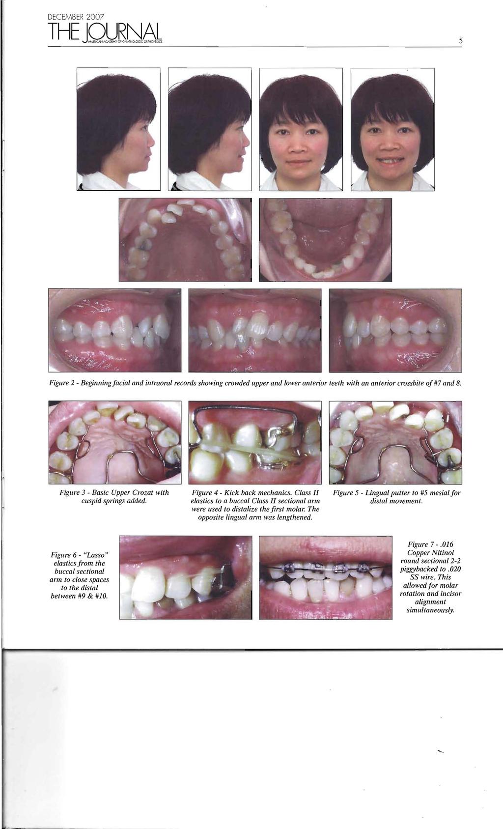 THE JQlJR~8L 5 Figure 2 - Beginning facial and intraoral records showing crowded upper and lower anterior teeth with an anterior crossbite of#7 and 8.