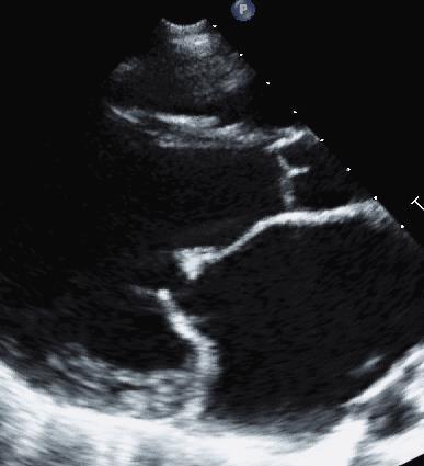 RHEUMATIC MITRAL STENOSIS AND INCOMPETENCE