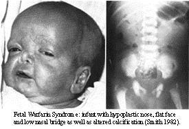 WARFARIN EMBRYOPATHY COAGUCHECK Nasal hypoplasia