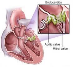 Endocarditis Prophylaxis at Delivery RECOMMENDED In the