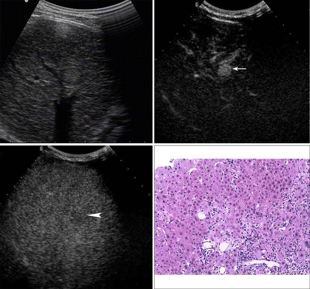 86 Wu et al. CEUS for diagnosis of DN-HCC in liver cirrhosis A B C D Figure 2 A 50-year-old man with hepatitis B related cirrhosis for 11 years.