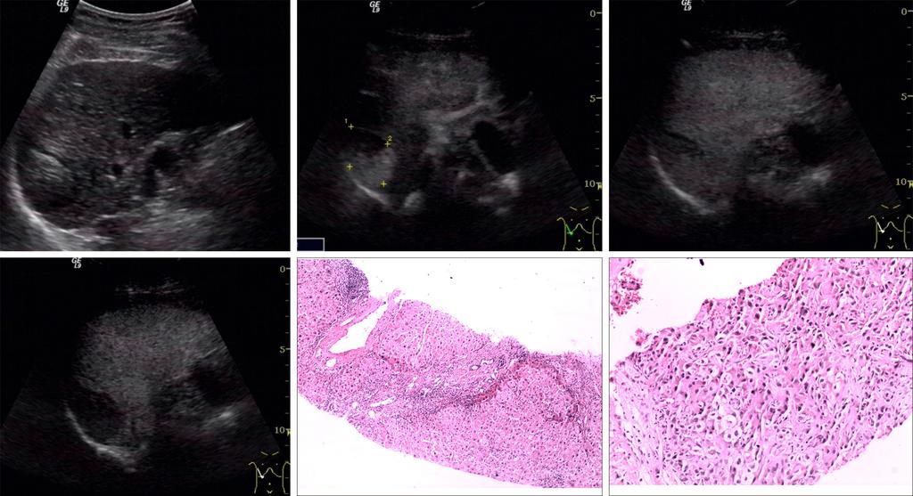 Chinese Journal of Cancer Research, Vol 27, No 1 February 2015 87 A B C D E F Figure 4 A 65-year-old man with hepatitis B for 20 years. (A) US shows a hyperechoic nodule with the size of 3.5 cm 2.