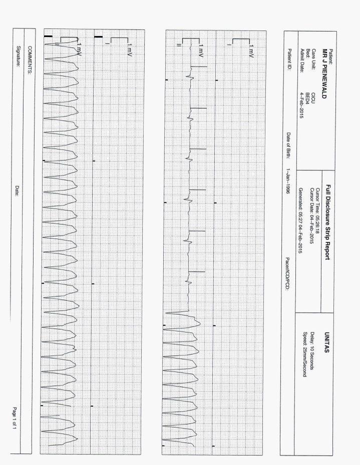 Ischemic Cardiomyopathy (LV ejection
