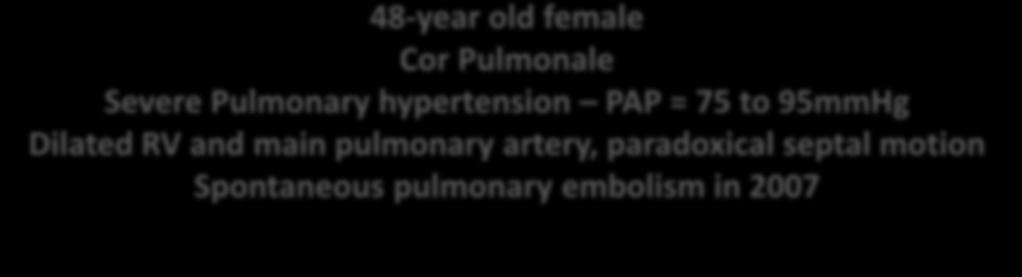 Dilated RV and main pulmonary artery,