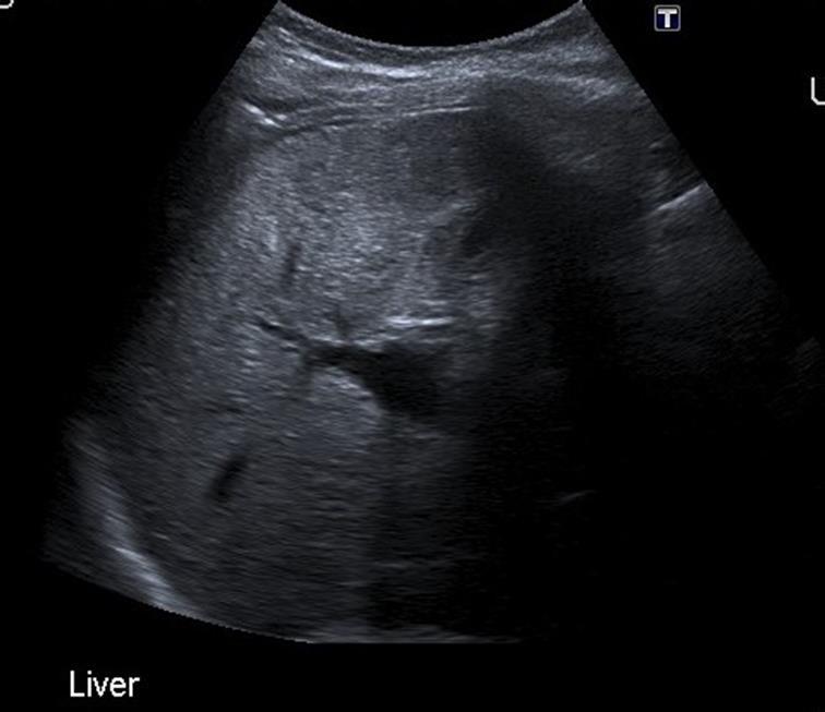 Ultrasound Features of a normal or fatty liver are well defined, specific and easily recognised The