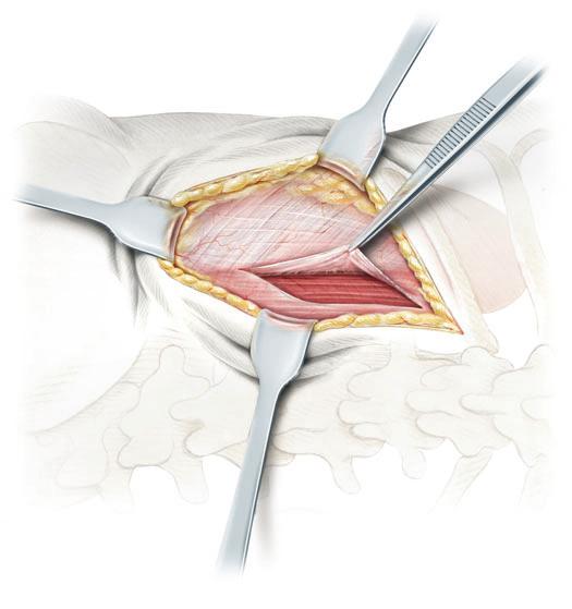 SURGERY ILLUSTRATED Figure 4 As the incision is deepened in its cranial portion, the posterior aspect of the lumbodorsal fascia is opened and the fibres of the sacrospinalis muscle uncovered.