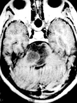 The lesion is seen compressing and pushing the 4th ventricle posteriorly.