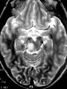 pilocytic astrocytoma The capillaries may be abnormal and can be coiled (angiomatous) and thick-walled. Apparently the blood-brain barrier is not well formed in these tumors.