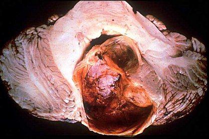 With progressive enlargement of the macrocysts (microcysts enlarge and coalesce forming a single large cyst), the viable tumor tissues are progressively compressed into a smaller, dense and