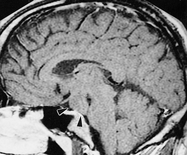 seizures and precocious puberty MRI: