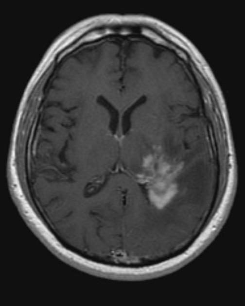 NeuroPathology P a g e 15 CNS lymphoma: MRI: