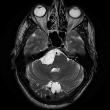 development MRI: CSF signal in T1/T2,