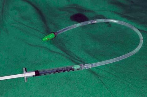 The hydraulic lifter provided in the kit is used to introduce 1 ml of sterile saline into the sinus cavity lifting the membrane with hydraulic pressure