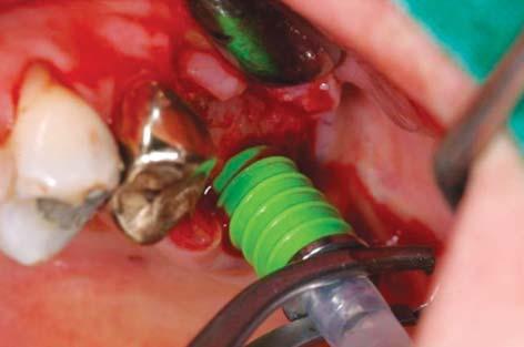 Bone graft material is then packed into the osteotomy and pushed into the sinus with a bone condenser that also has the metal stopper attached to prevent