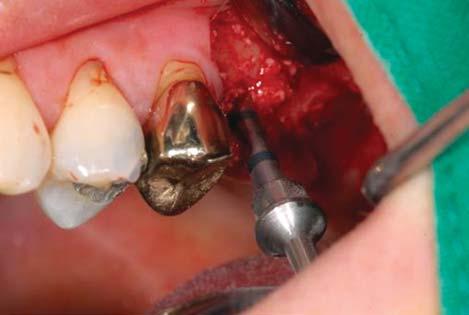 DISCUSSION During the past 35 years, sinus lift procedures have become a common and predictable surgical procedure for implant Fig.