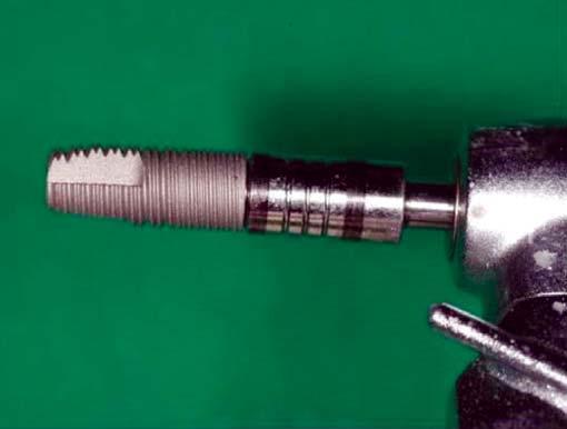 15: HG II implant (Hiossen) on handpiece ready to be