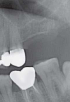 16: Implant introduced into the osteotomy following sinus