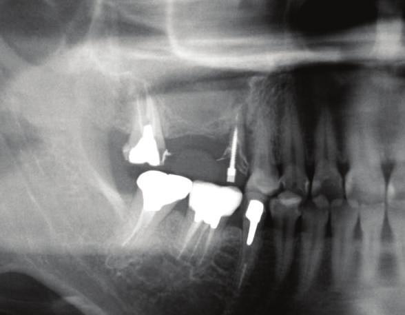2 Case Reports in Dentistry Figure 1: A panoramic radiograph reveals the residual bone height to be low at the first molar site. 2.