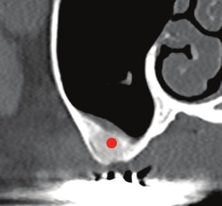 Figure 4: The initial panoramic radiograph revealed severe bone loss around R3 and L2 implants.