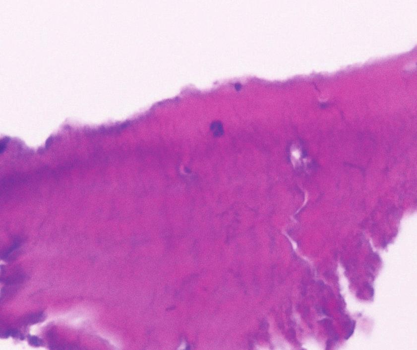 24 months after surgery using PRF only shows extremely mature bone tissue (H-E staining).