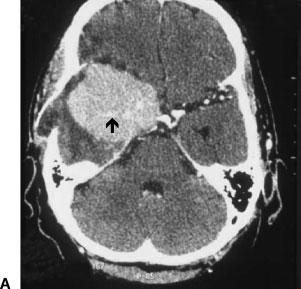 212 SKULL BASE: AN INTERDISCIPLINARY APPROACH/VOLUME 15, NUMBER 3 2005 Figure 7 (A) A 45-year-old male with two previous resections of an atypical meningioma.