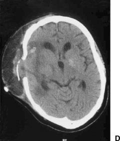tumors. All five cases at the time of the bypass procedure had atypical meningiomas. The age range was 25 to 45 years with three male and two female patients.